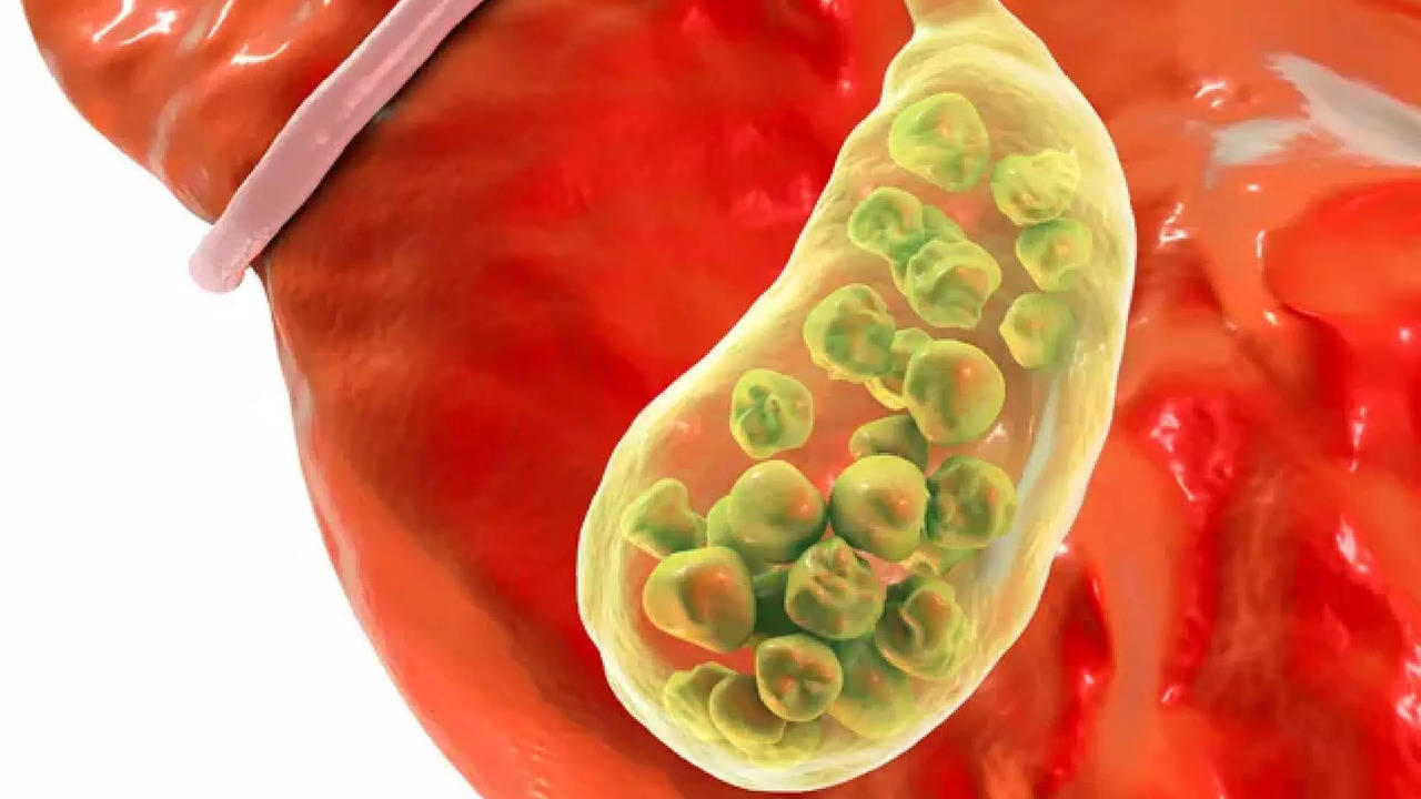 gallbladder stone