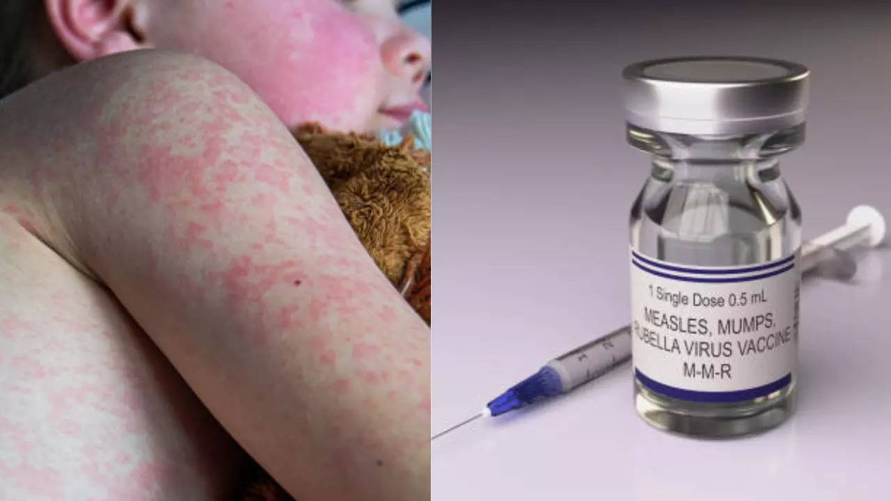 The US reports new cases of measles in Texas and New Mexico; This is why the number is increasing