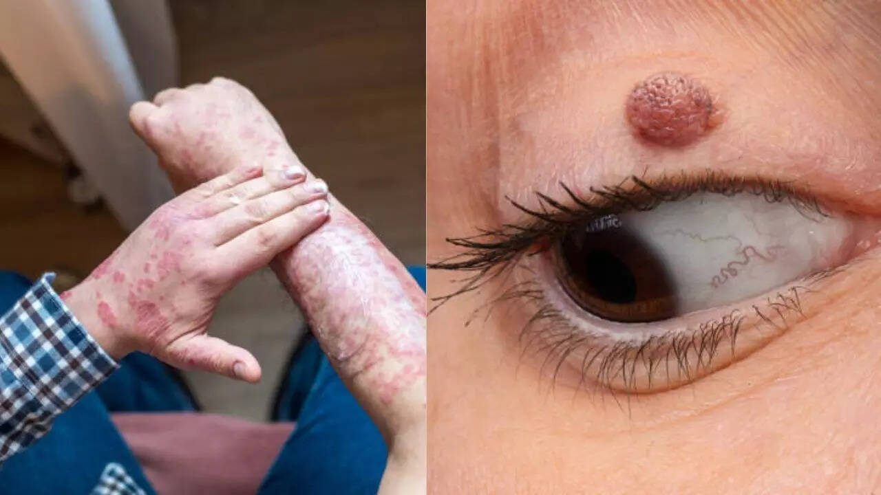Symptoms of High Cholesterol That Show Up on Your Skin