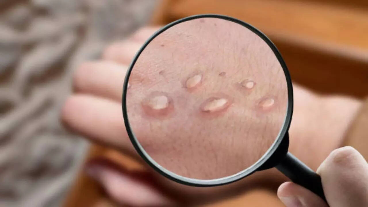 UAE, New York MPOx confirms the first cases of New Strain; Know the symptoms of this highly infectious viral infection UAE, New York MPOx confirms the first cases of New Strain; Know the symptoms of this highly infectious viral infection