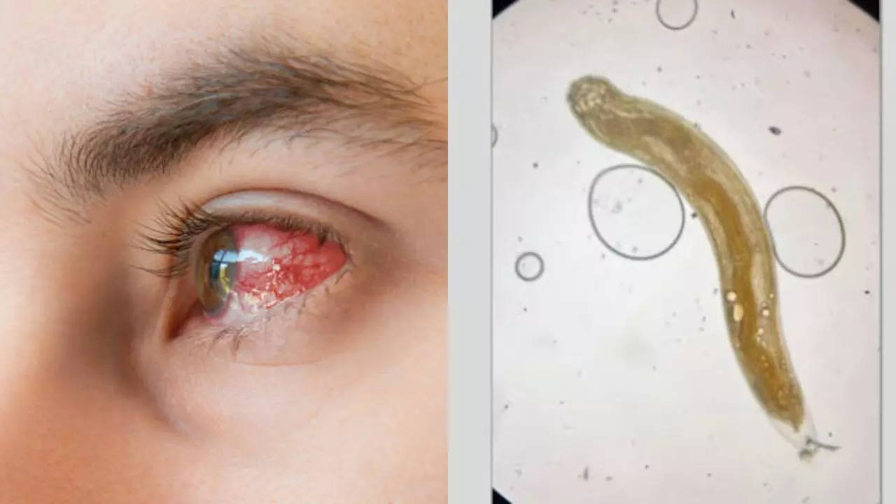 Doctors remove a living worm from a man’s eye; Learn how to know this