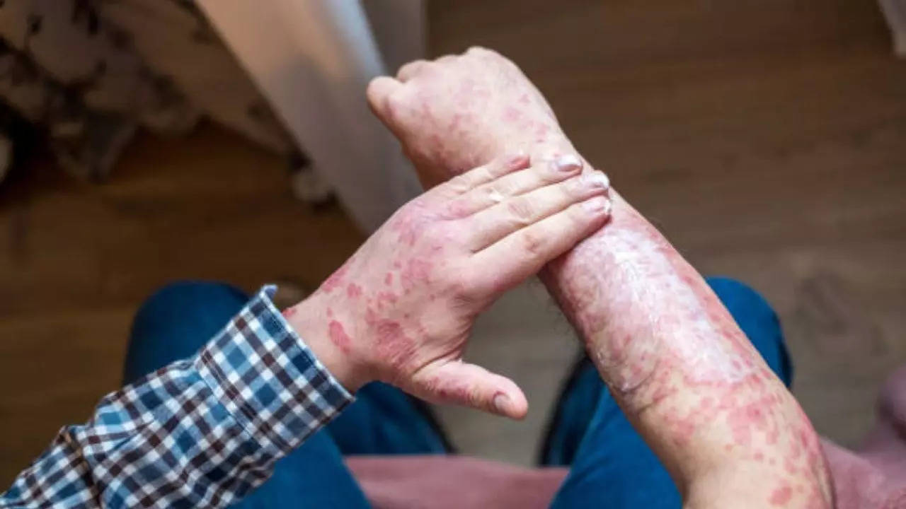 Poor hygiene does not cause psoriasis; Here it leads to this chronic skin condition