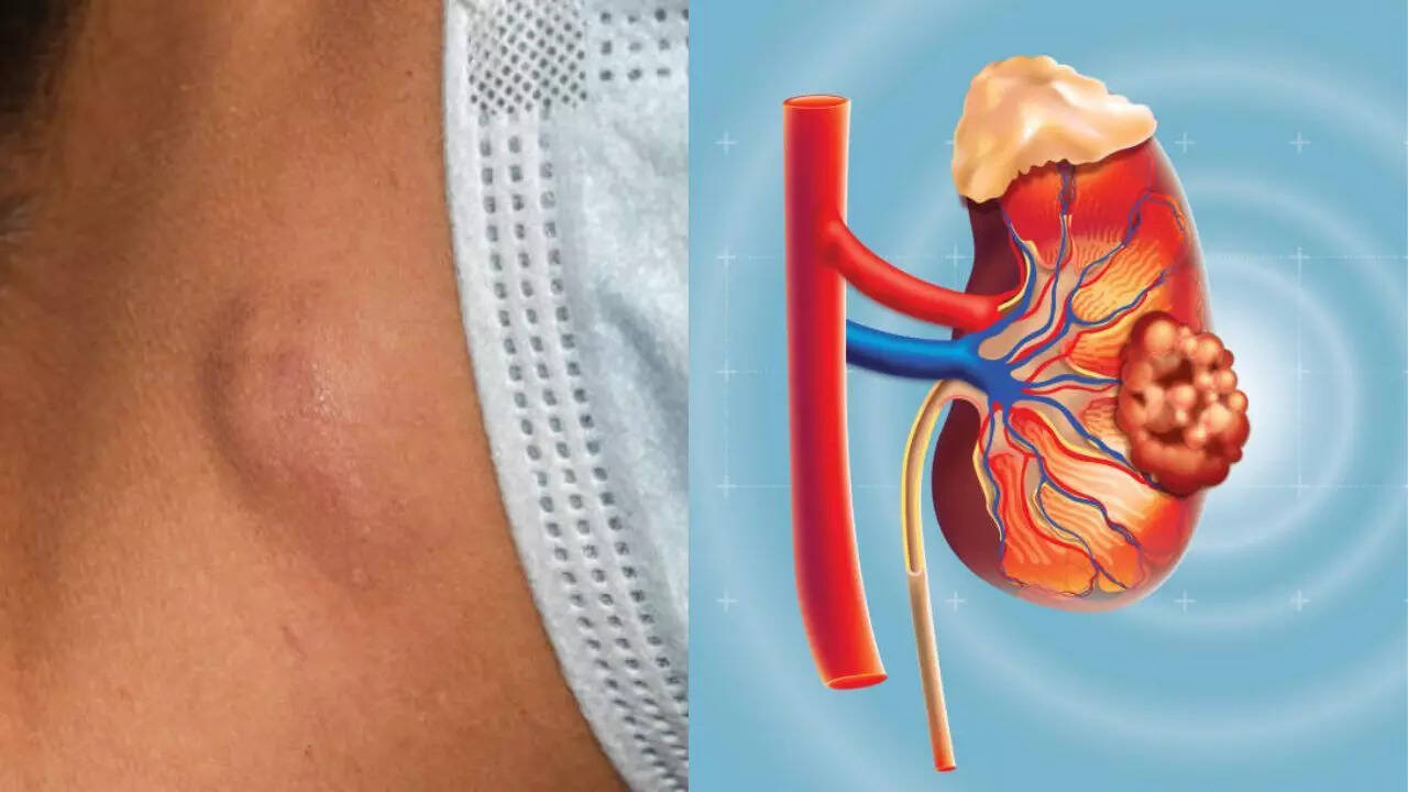 This symptom in your neck can mean kidney cancer, warning doctors; Learn the signals you should not ignore This symptom in your neck can mean kidney cancer, warning doctors; Learn the signals you should not ignore