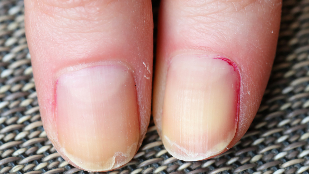 Is the skin peeling around your nails painful? This may indicate vitamin deficiency Is the skin peeling around your nails painful? This may indicate vitamin deficiency