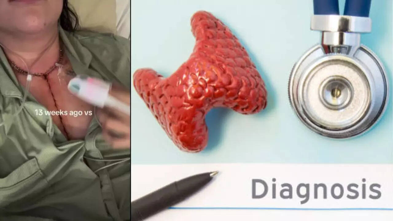 A woman who is dismissed as anxiety is diagnosed with 204 cancer lumps, caused by marrow thyroid cancer; What is this?