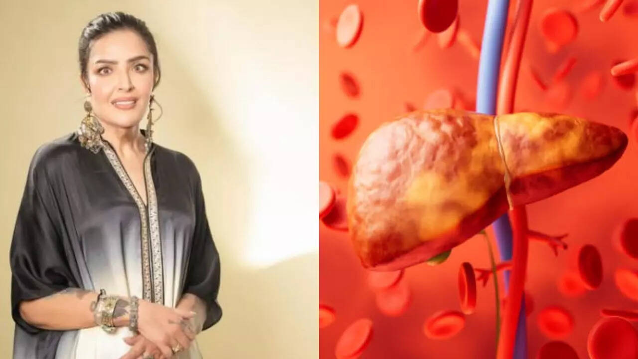 Hrithik Roshan’s sister Sunaina revealed how she reversed grade 3 fatty liver with a simple lifestyle Hrithik Roshan’s sister Sunaina revealed how she reversed grade 3 fatty liver with a simple lifestyle