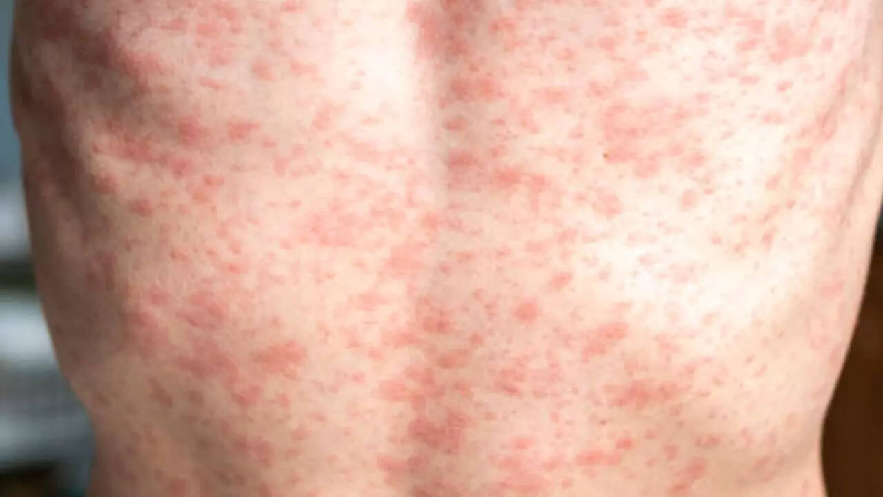 CDC alarm seems because measles spreads throughout America – are you at risk? CDC alarm seems because measles spreads throughout America – are you at risk?