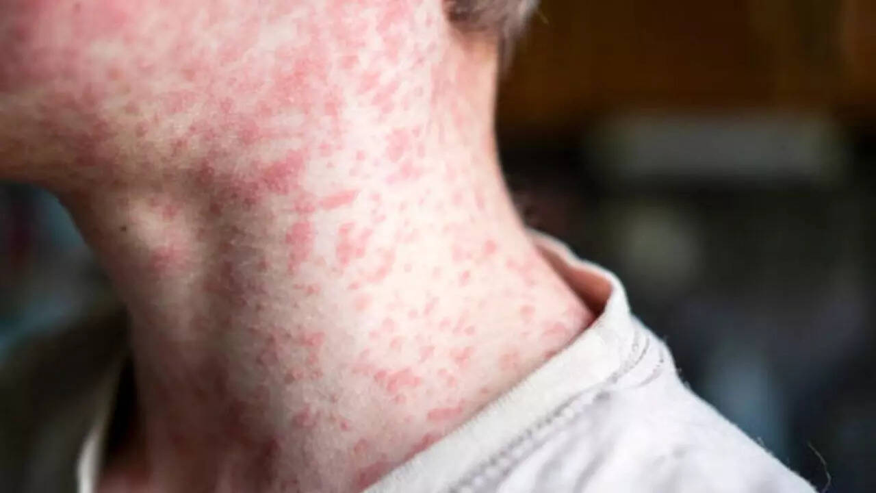 Canus reports the outbreak of measles with 23 cases as the infection increases in the US Canus reports the outbreak of measles with 23 cases as the infection increases in the US