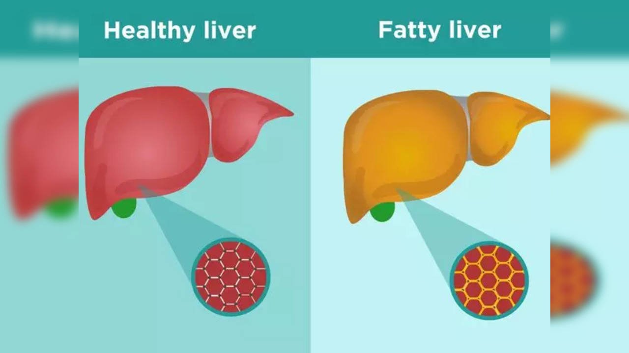 fatty liver