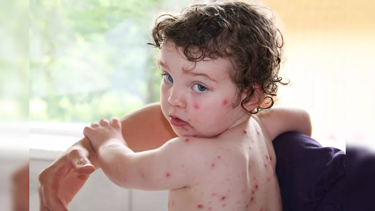 chickenpox symptoms