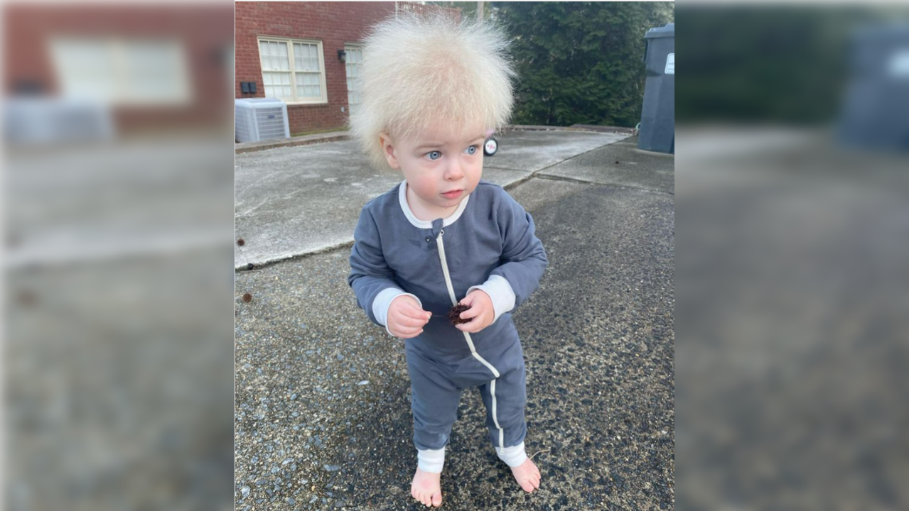 Locklan's uncombable hair syndrome