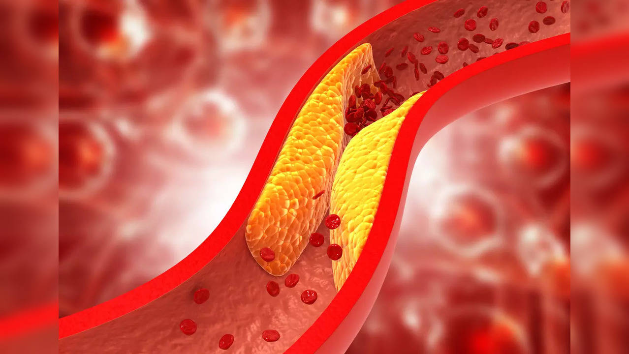 Cholesterol plaque can clog arteries.