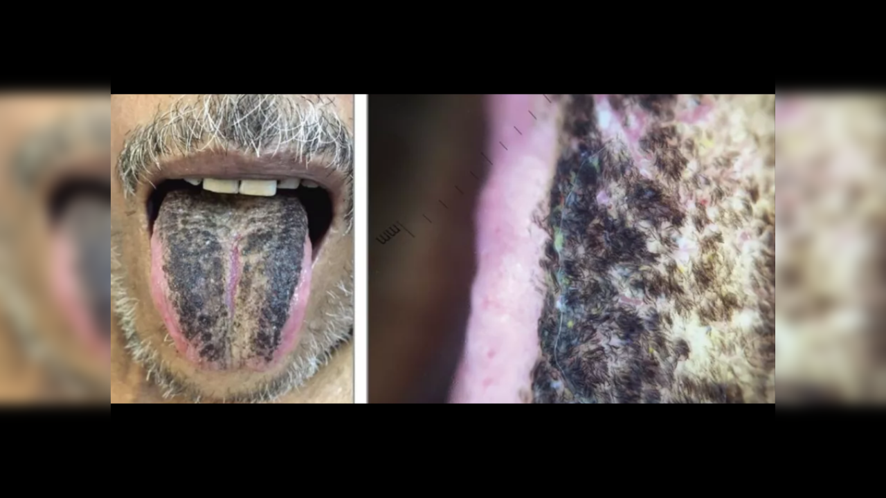 Man starts growing thick black 'hair' on his tongue - turns out it's a common condition - Times Now