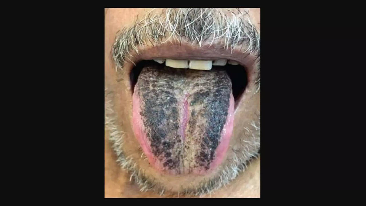 Hairy Tongue Why It Happens and How to Treat It