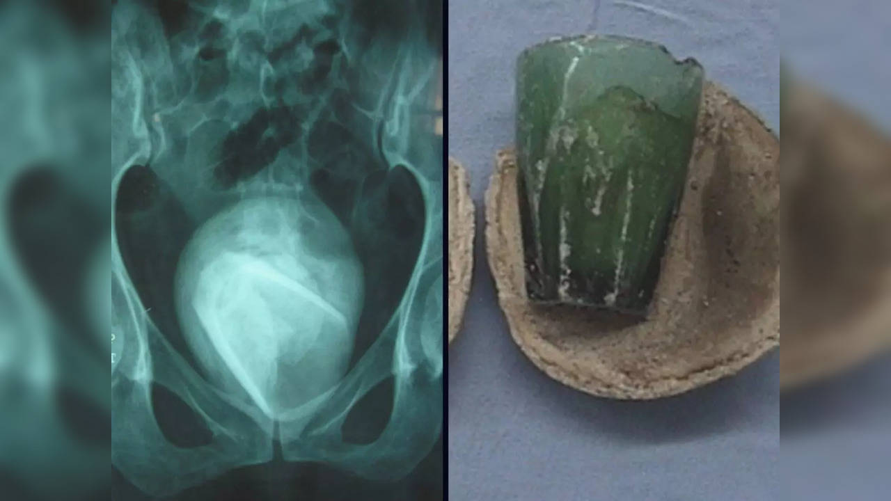 Doctors Found A Glass Tumbler Was Cause Of A Woman's UTI Symptoms