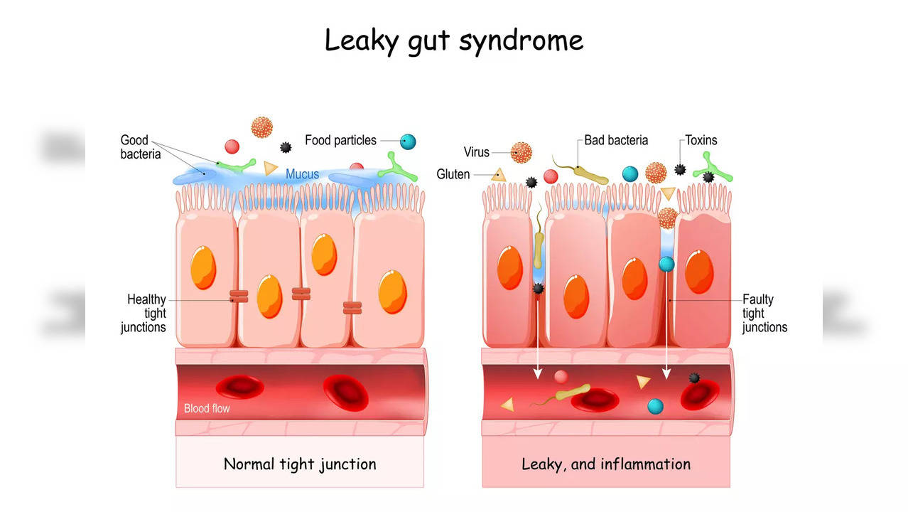 Leaky Gut syndrome explained