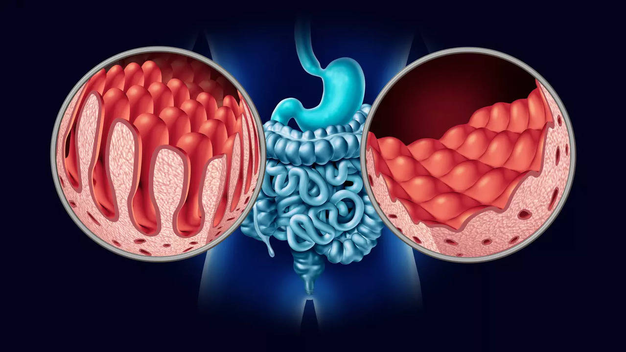 coeliac disease