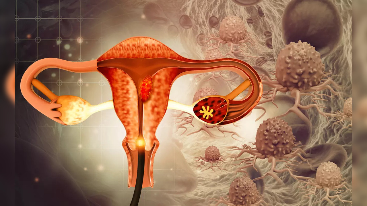 Ovarian cancer: Top 3 silent signs that often go overlooked, tips to ...