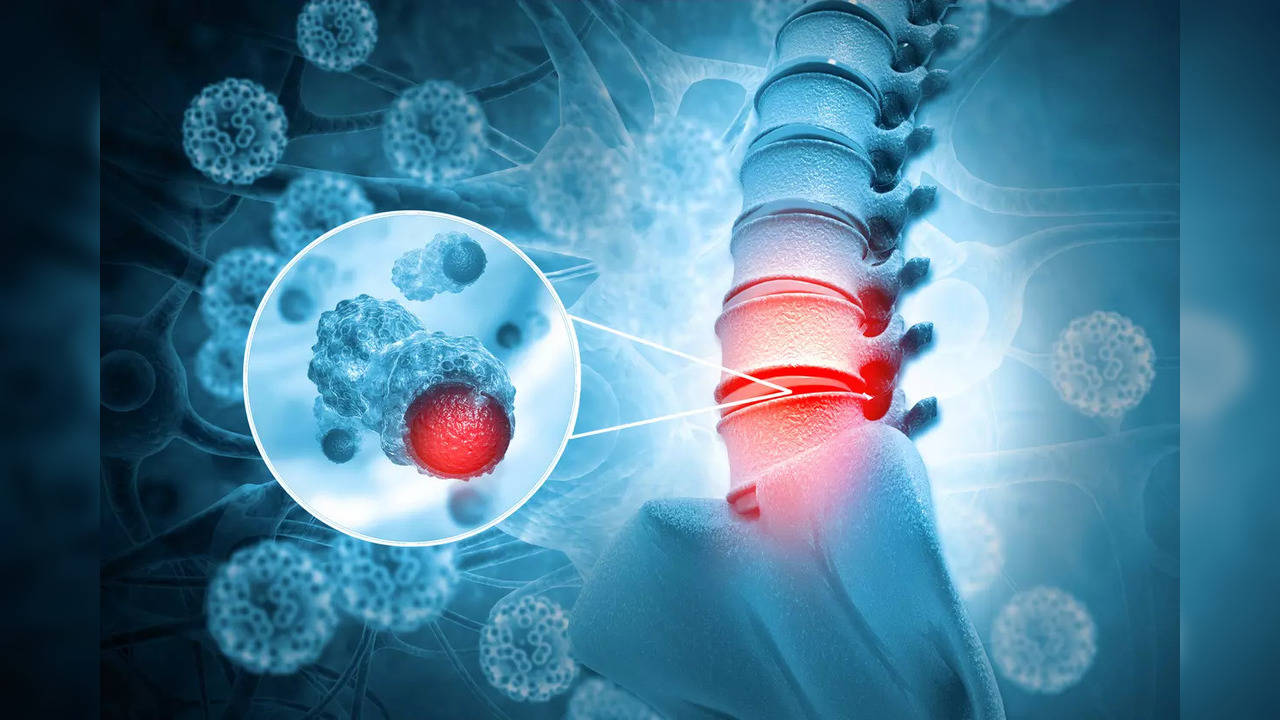 spinal tumour