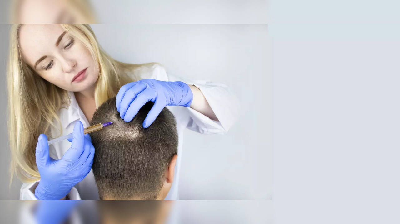 Common arthritis drug holds the promise of treating severe Alopecia