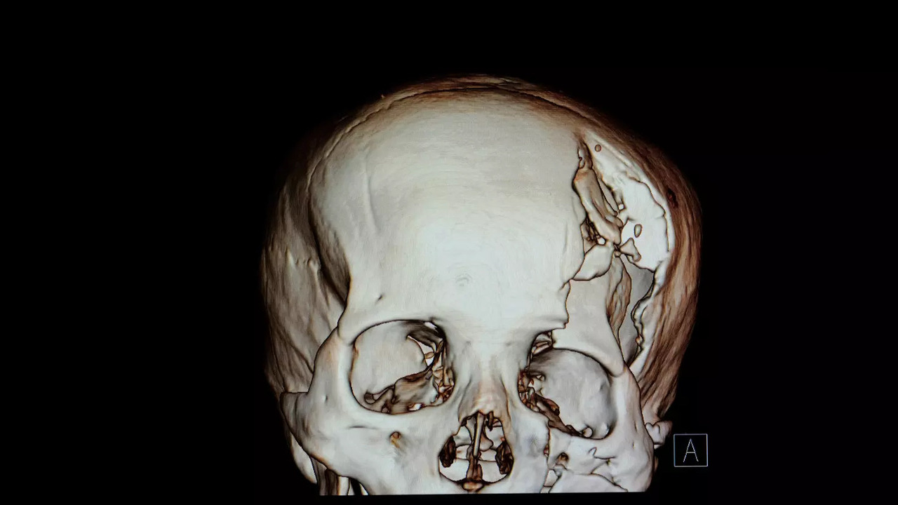 A depressed skull fracture is when a part of the skull bone sinks in from the injury, in most cases, it needs surgical treatment.