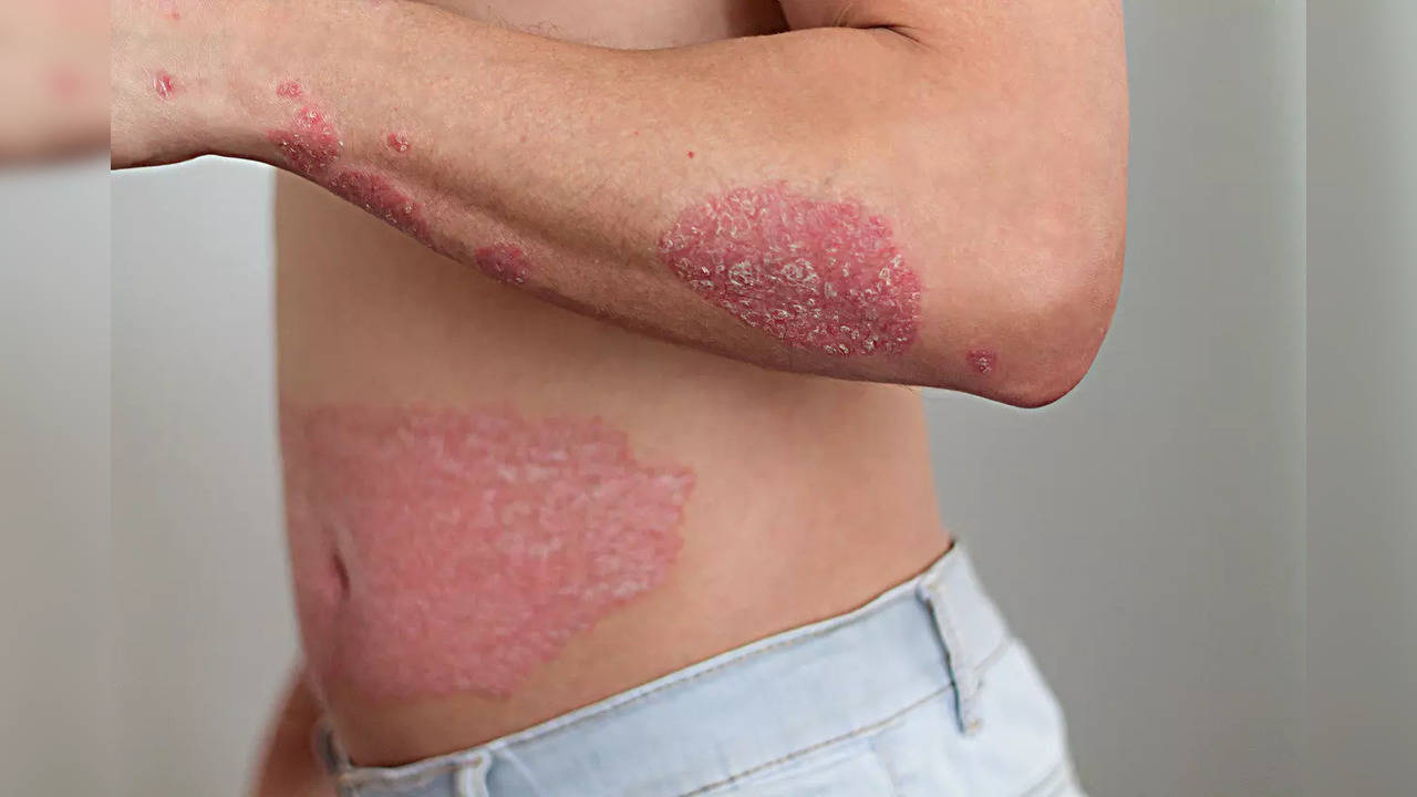 Psoriasis symptoms depend on the type of the disease one is suffering from.