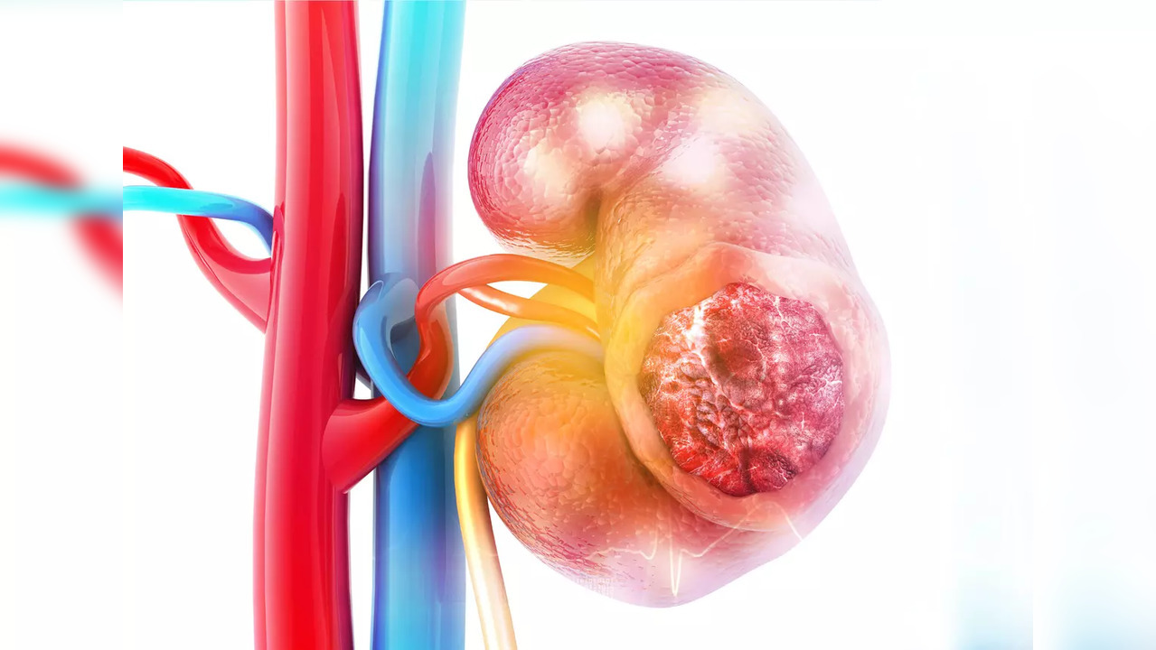 A new study has found that cancer cells can disrupt a metabolic pathway that breaks down fats and proteins to boost the levels of a byproduct called methylmalonic acid, thereby driving metastasis.