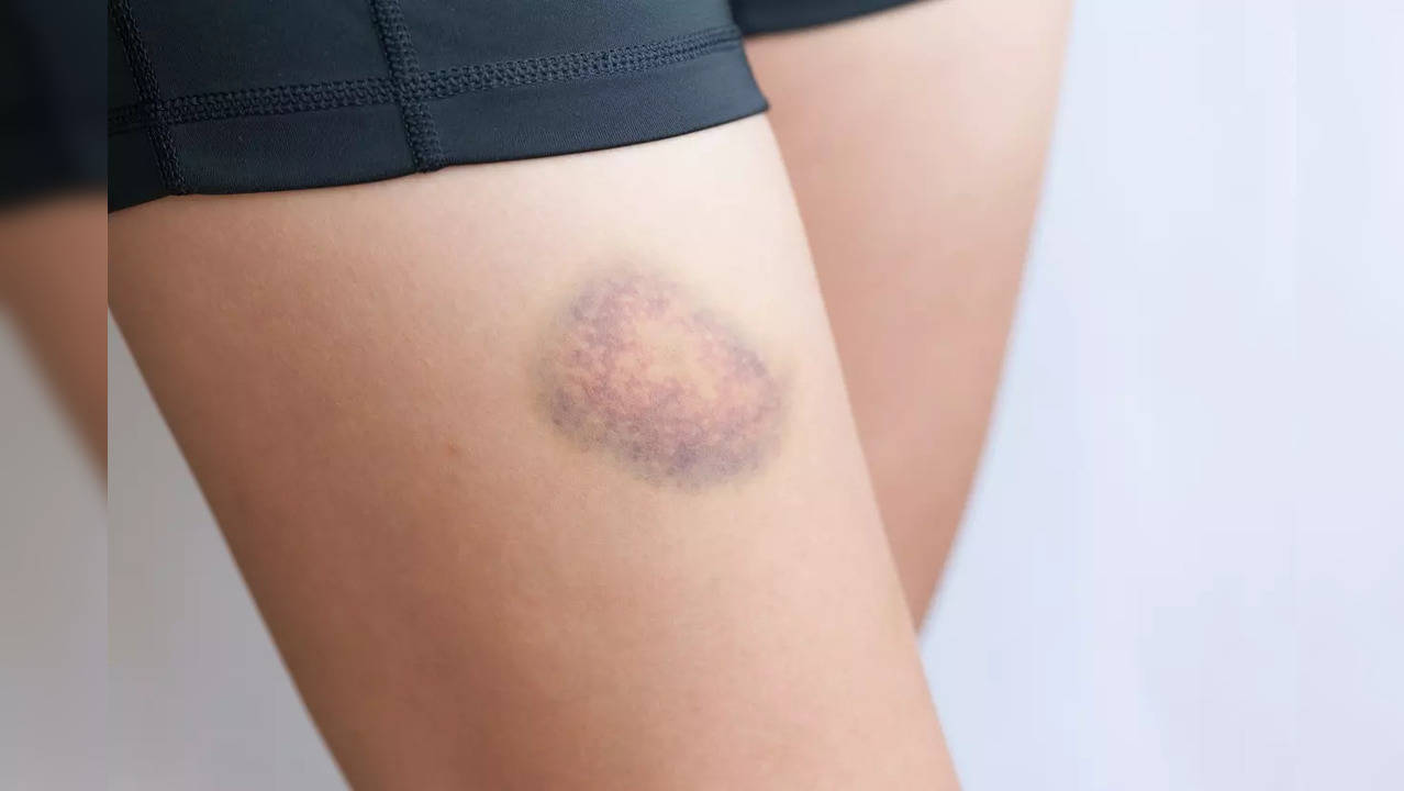 Blood clot or bruise? Know the symptoms to tell them apart