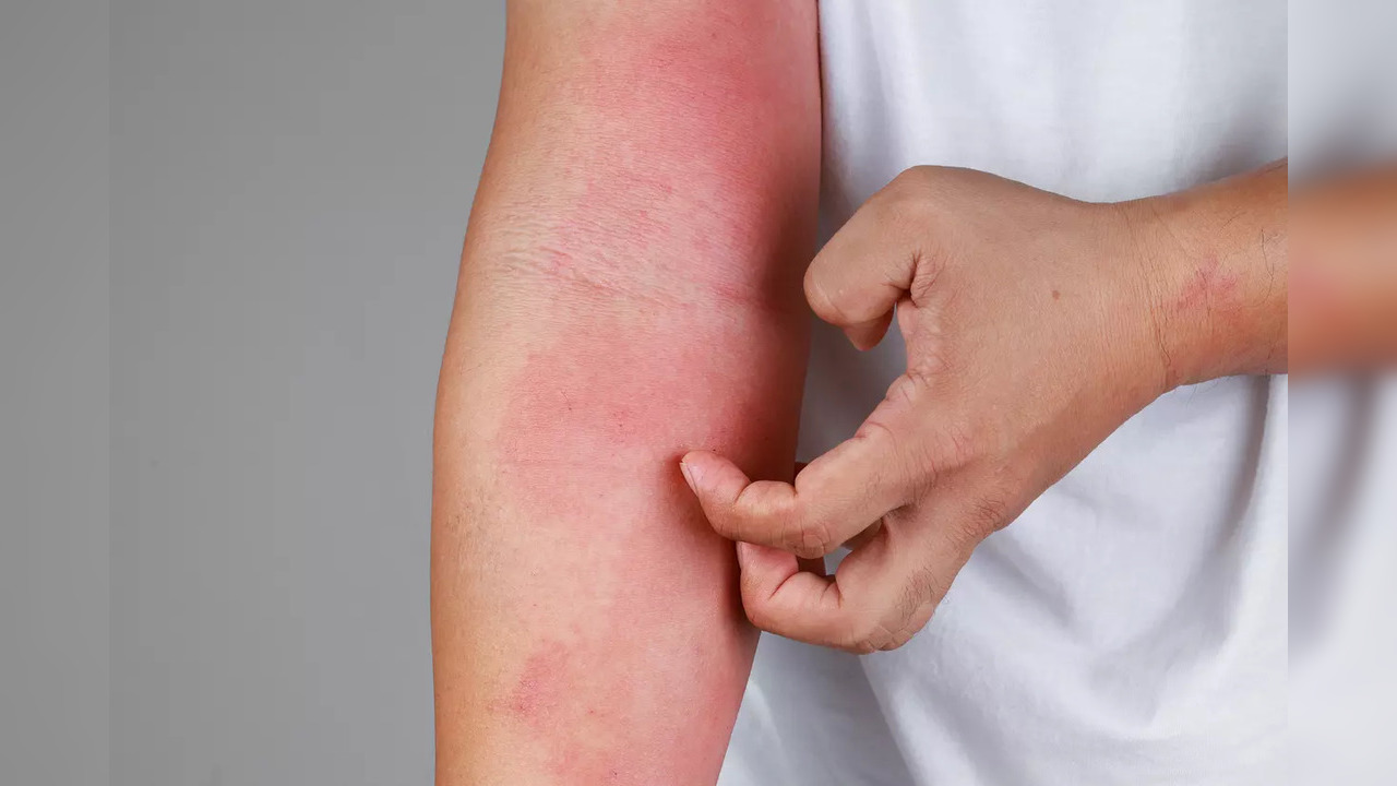 Secret triggers that might be causing your eczema flare-ups