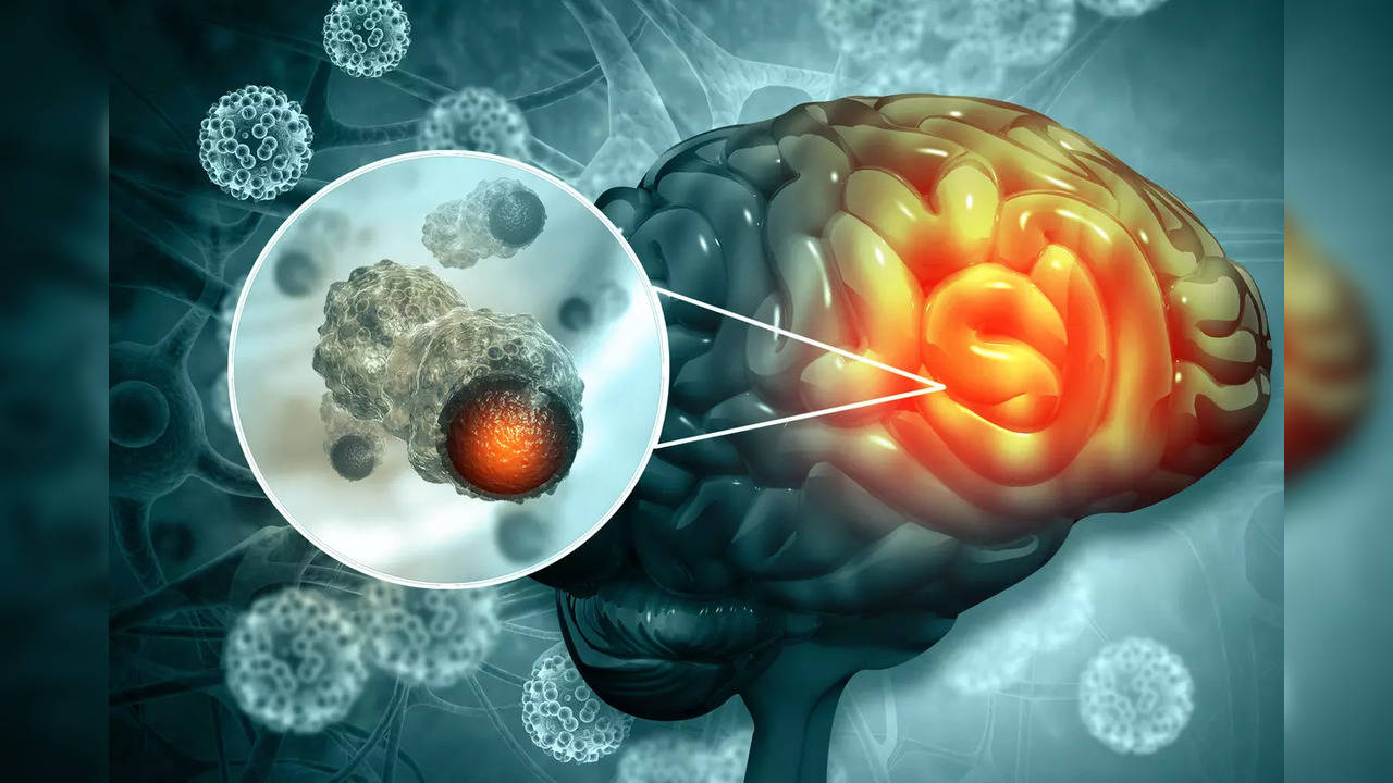 Glioblastoma is resistant to treatment as the cells within the tumour are all of different types.