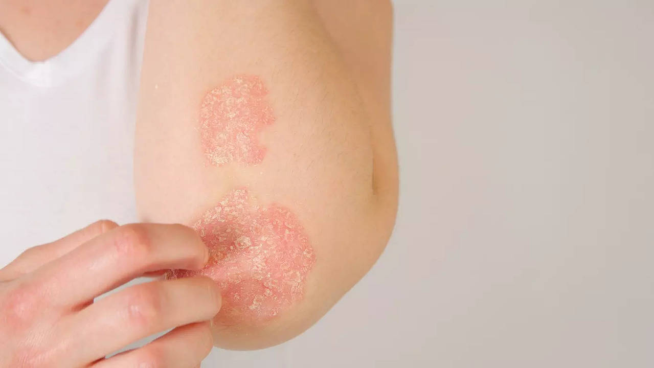 According to experts, the raised patches on skin can be red, dark brown or pink depending on the skin tone.