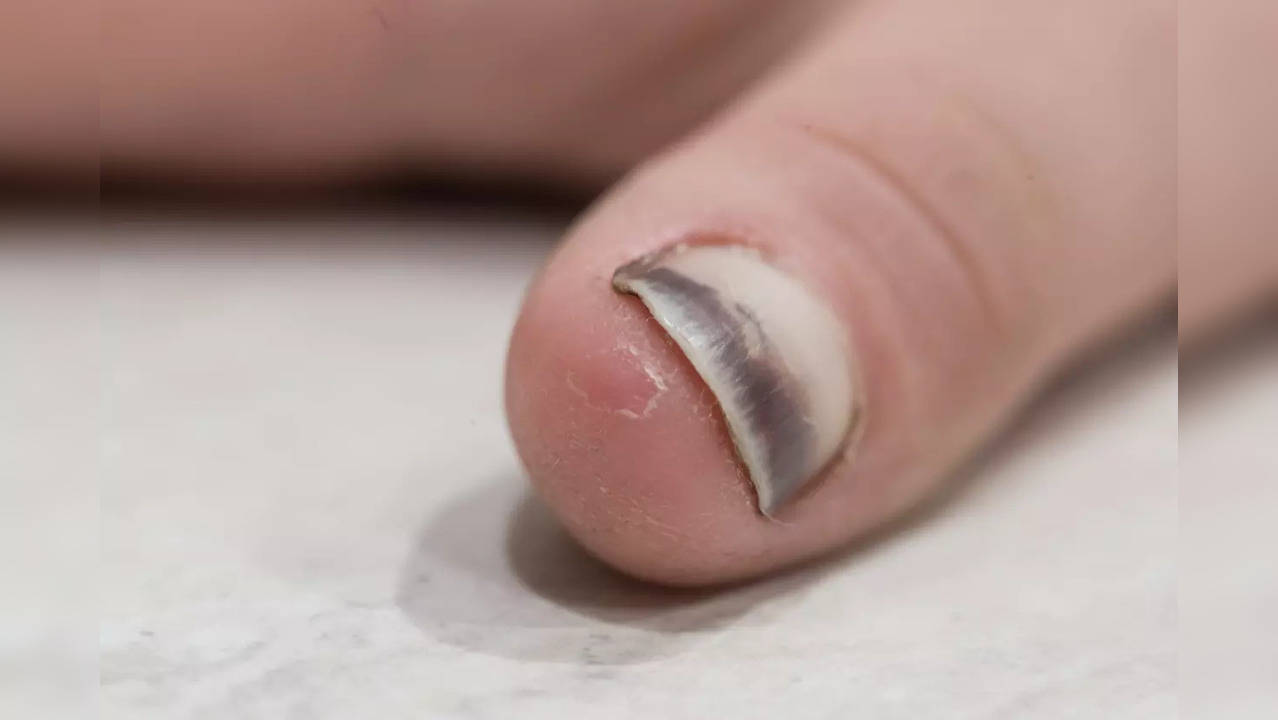 COVID Nails: Pictures, Types, Prognosis