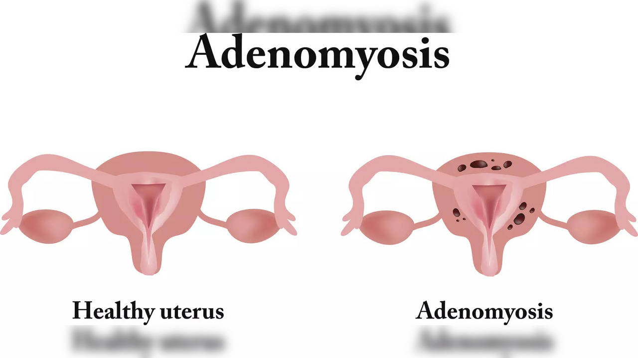 Adenomyosis: Know the signs, causes, and treatment of the condition