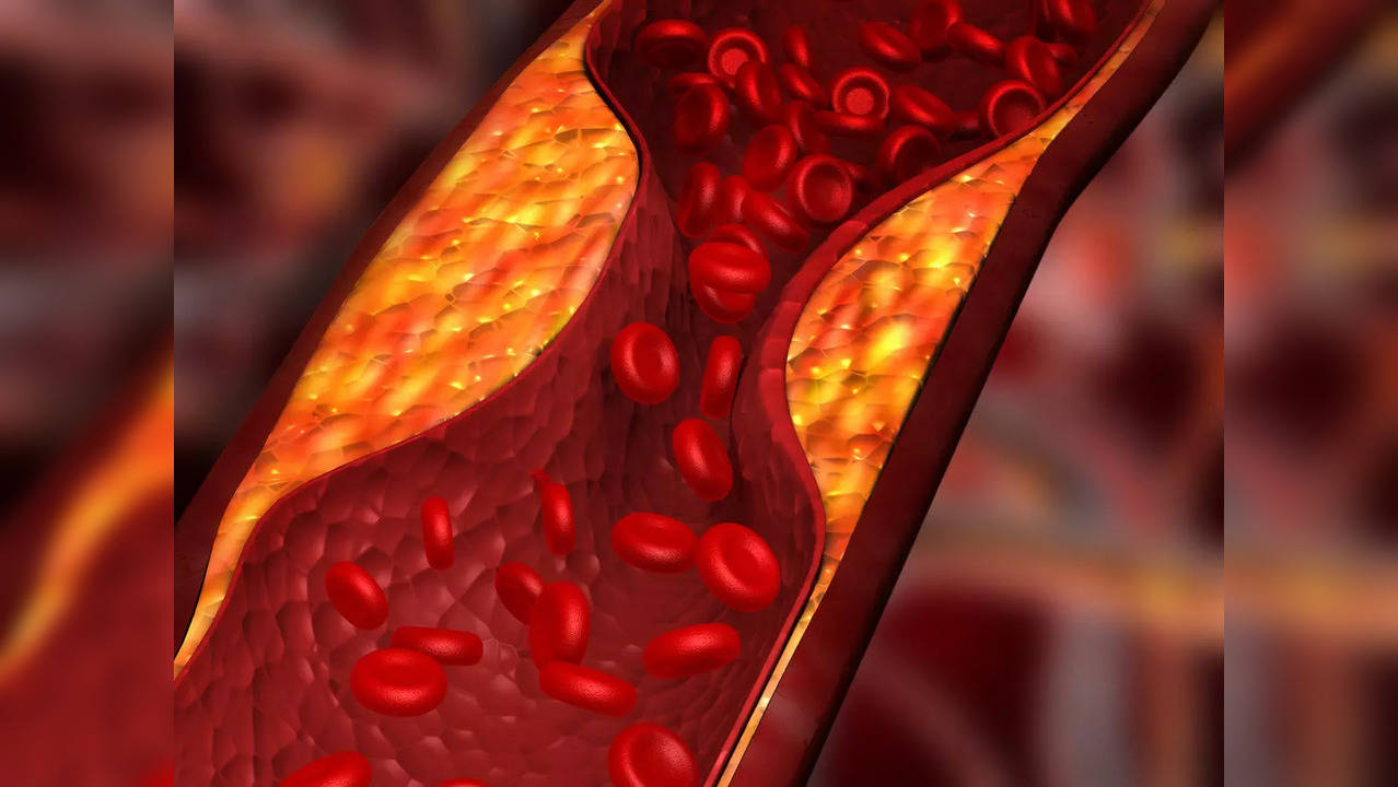 Hypercholesterolemia: Know the signs and management tips