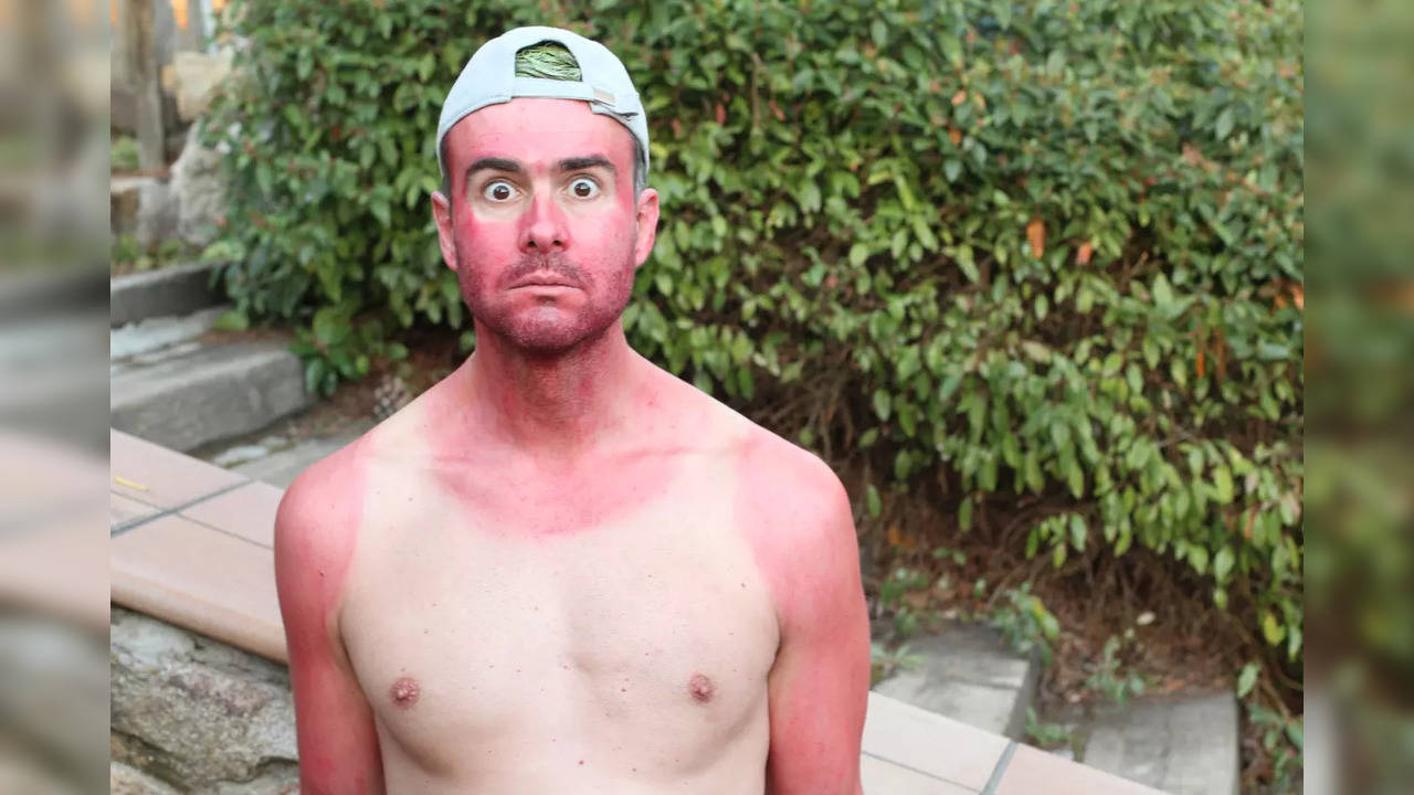 Sun poisoning is severe sunburn that has symptoms similar to an allergic reaction.
