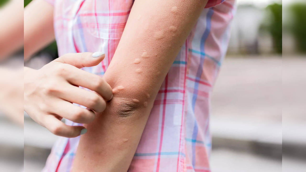 Monkeypox virus: Know the stages of rash progression