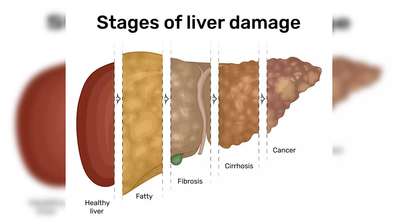 Fatty liver disease: 3 surprising signs to look out for