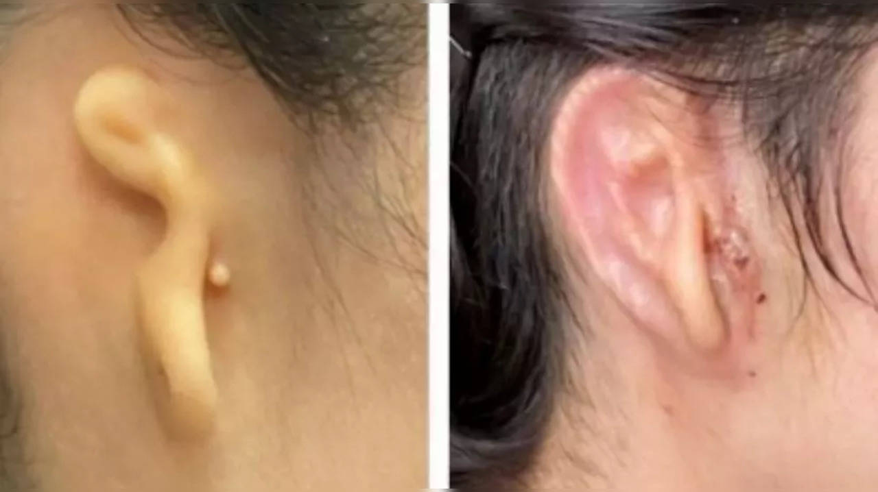 The implant is specifically for patients with microtia, a rare congenital deformity where one or both outer ears are absent or underdeveloped.