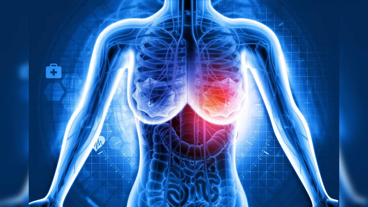 New gene drug improves breast cancer patients' survival rate
