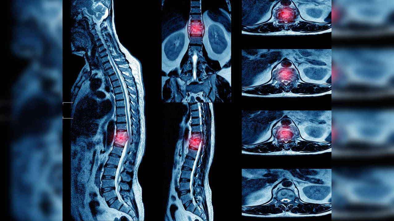 spondylodiscitis