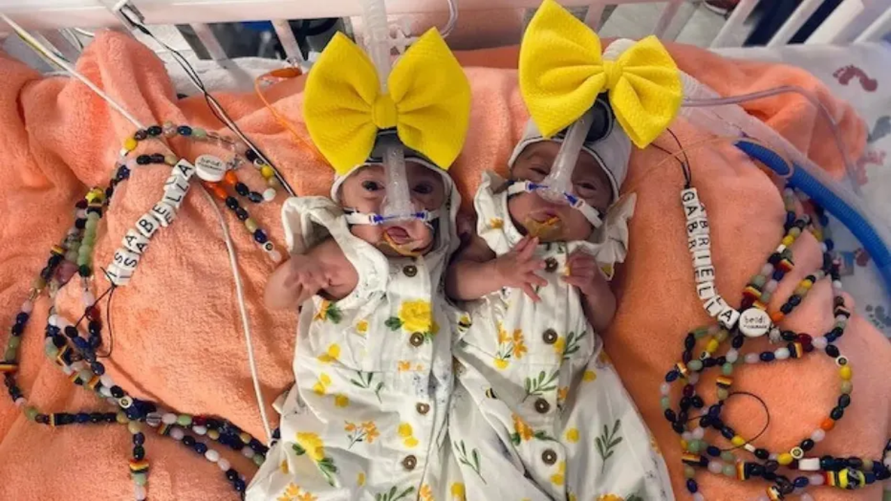 Mom gives birth to identical twins 3 days apart