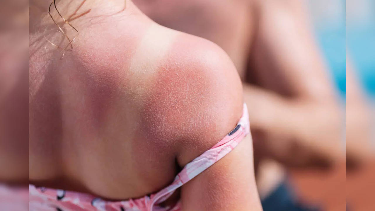 Heatwave alert: Tips to keep skin safe against sun damage during summers