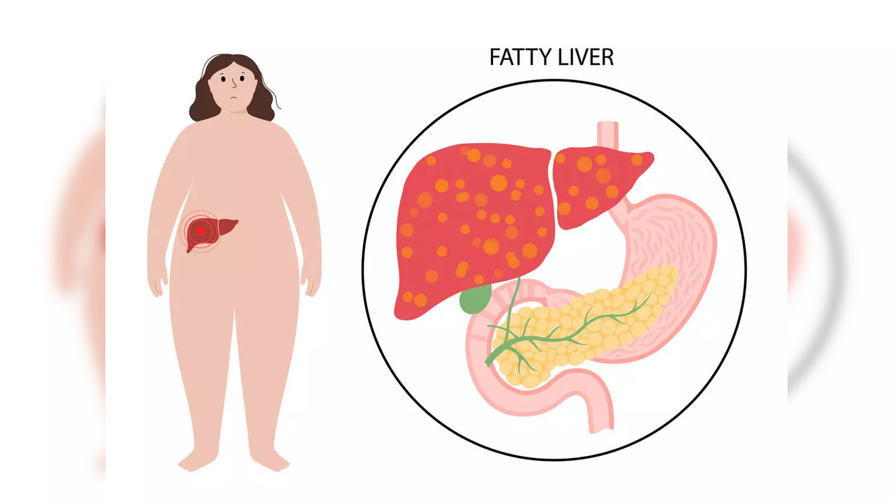 40 per cent in India suffer from non-alcoholic fatty liver: Doctors