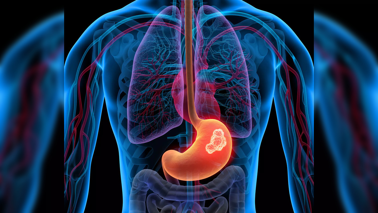 Stomach cancer symptoms depend on where the tumour has formed.