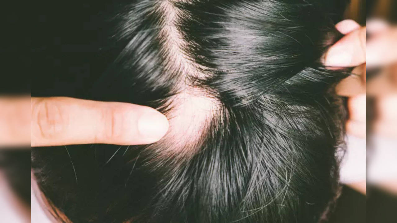 A strand of hope: Oral pill to treat alopecia, restore hair growth approved by US FDA86