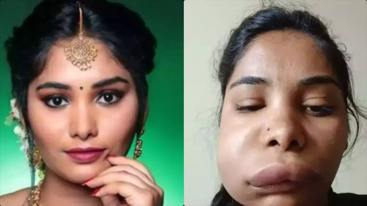 Kannada actress Swathi Sathish gets a swollen face after botched root