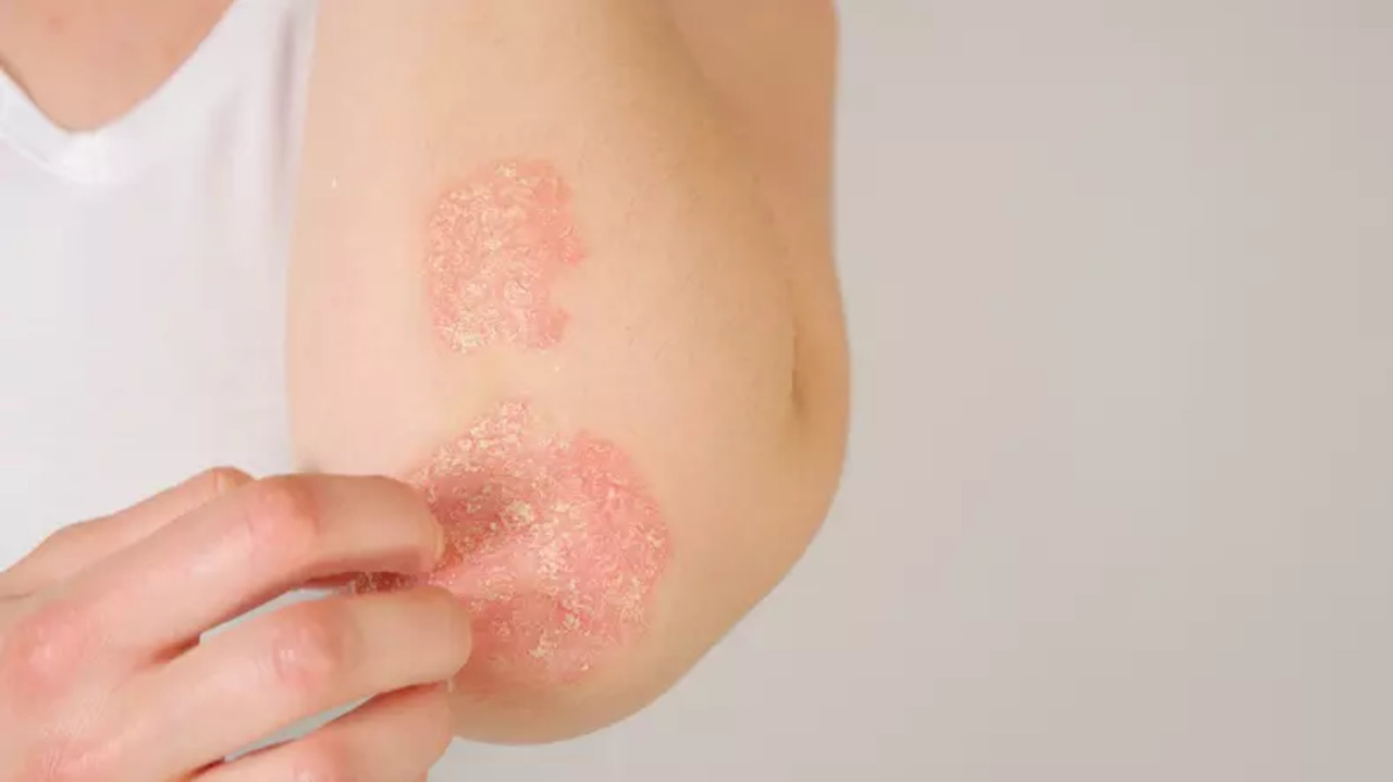 psoriasis