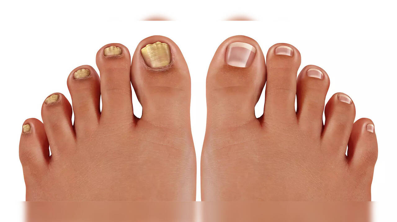 Heard of Onychomycosis? That's toenail fungal infection: 7 steps to prevent fungus growth on the foot Heard of Onychomycosis? That's toenail fungal infection: 7 steps to prevent fungus growth on the foot