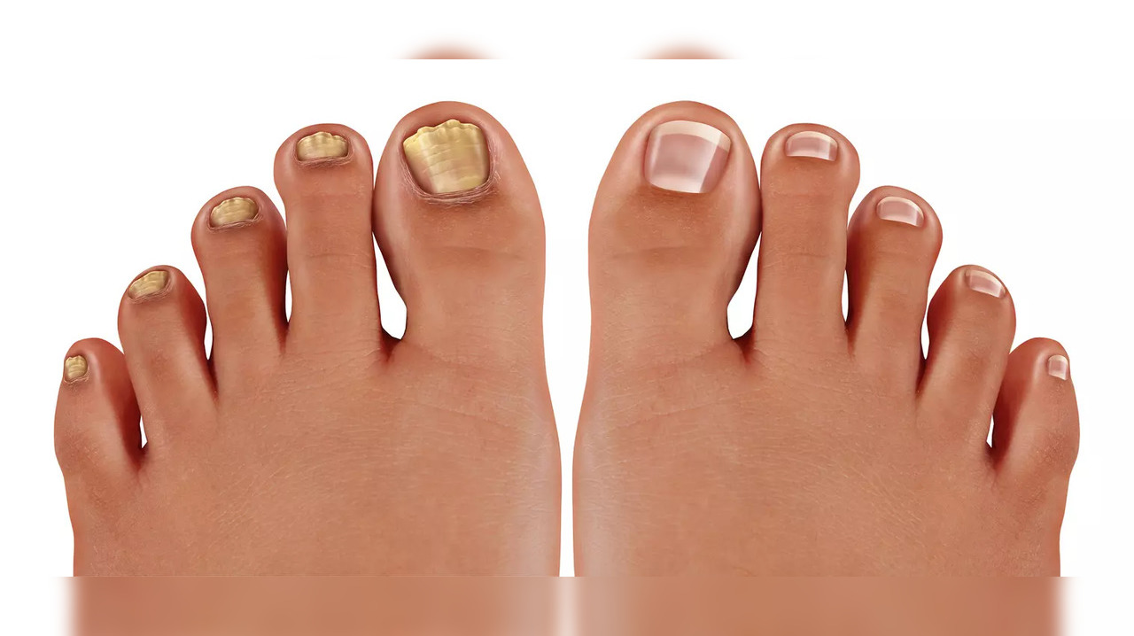 Toenail fungus athlete's foot fungal growth infection