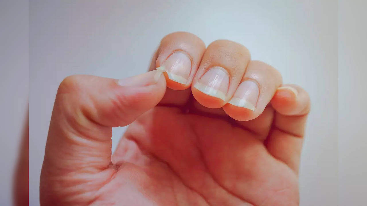 Splitting and Peeling Nails | SheCares